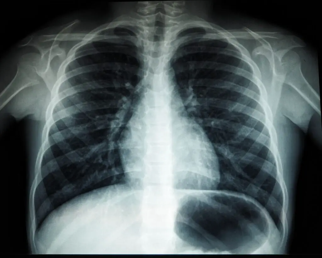 rib cage x ray