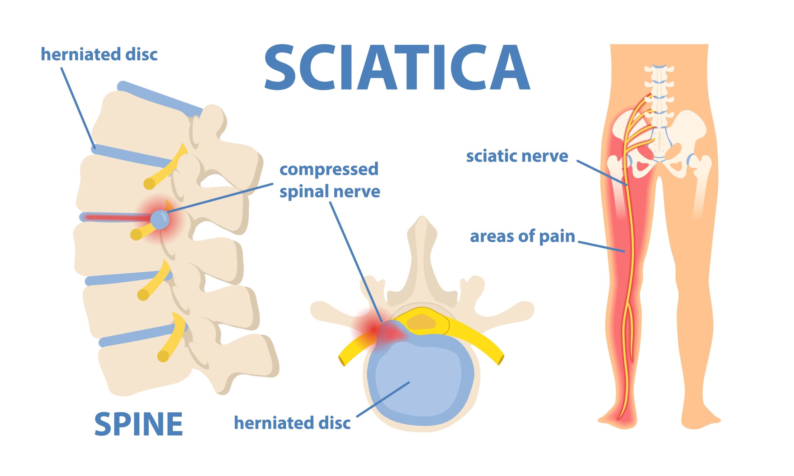 sciatica temporary or permanent