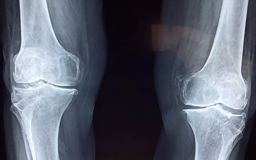 knee x ray bilateral